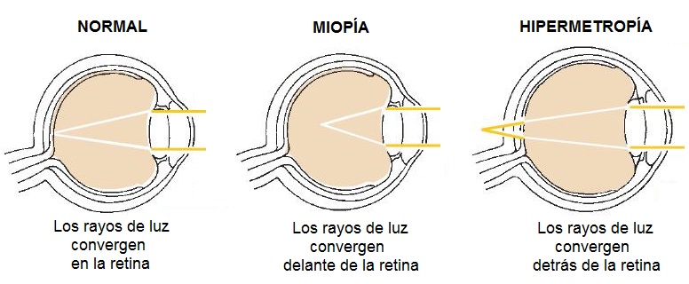 Hipermetropia, Emetropia e Miopia | PDF | Lente (Ótica) | Olho