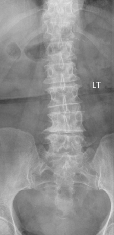 Radiografia amb artrosi lumbar