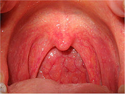 Faringitis: infecció vírica de la faringe