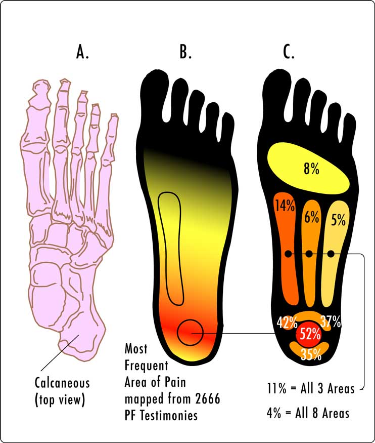 Regions de la planta del peu on és més freqüent el dolor